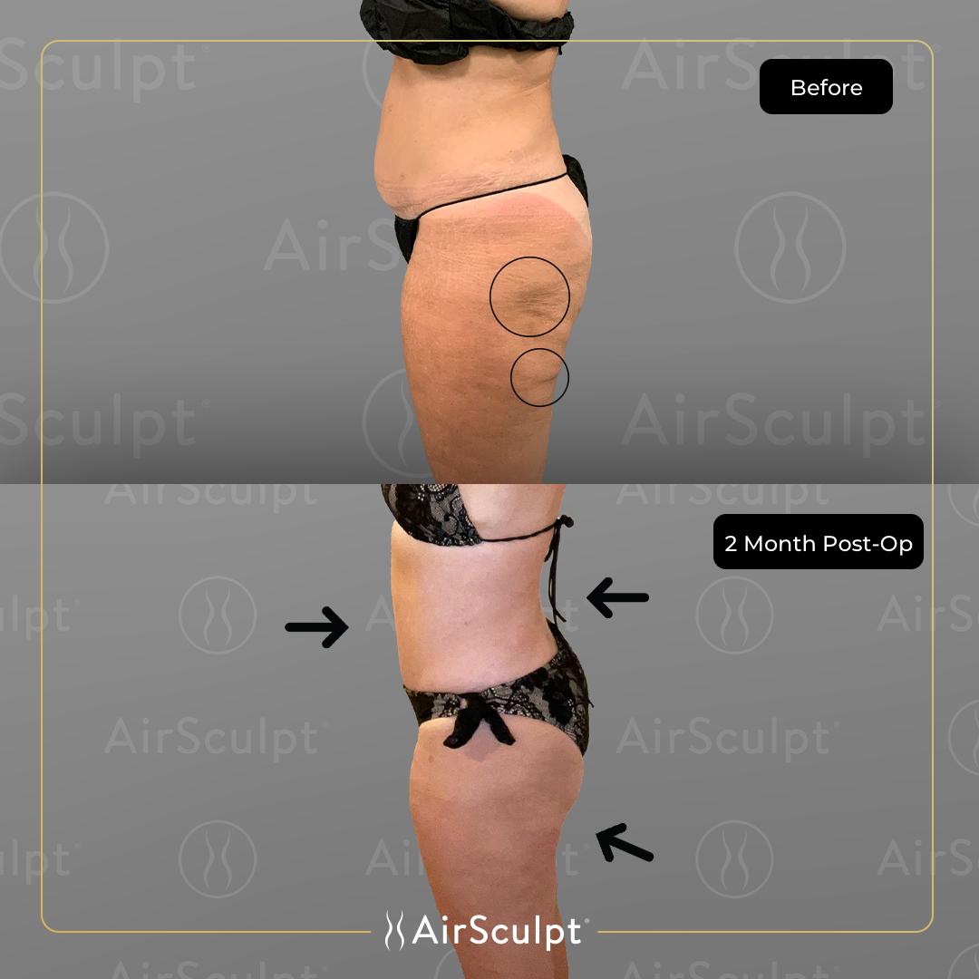 Vicki Gunvalson's before and after using AirSculpt